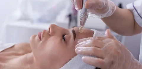 Best Microneedling Services in Plano for Skin Renewal