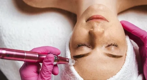 Best SkinPen Treatments in Plano for Fresh, Smooth Skin