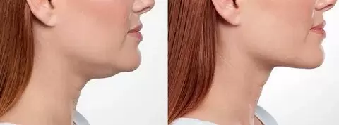 How Many Kybella Treatments Do You Need